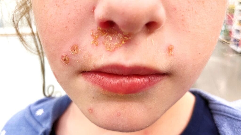 Impetigo Face OneMedicine Private GP clinic