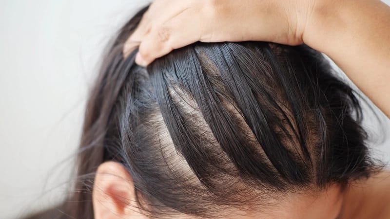 hair loss thinning vitamins