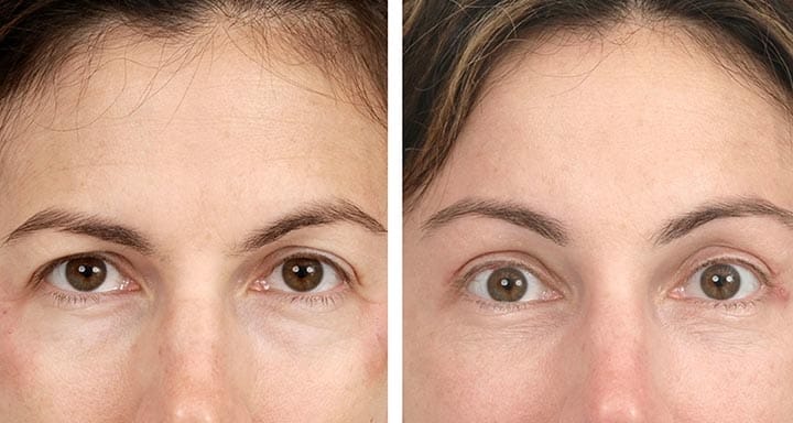 Tear trough under eye filler