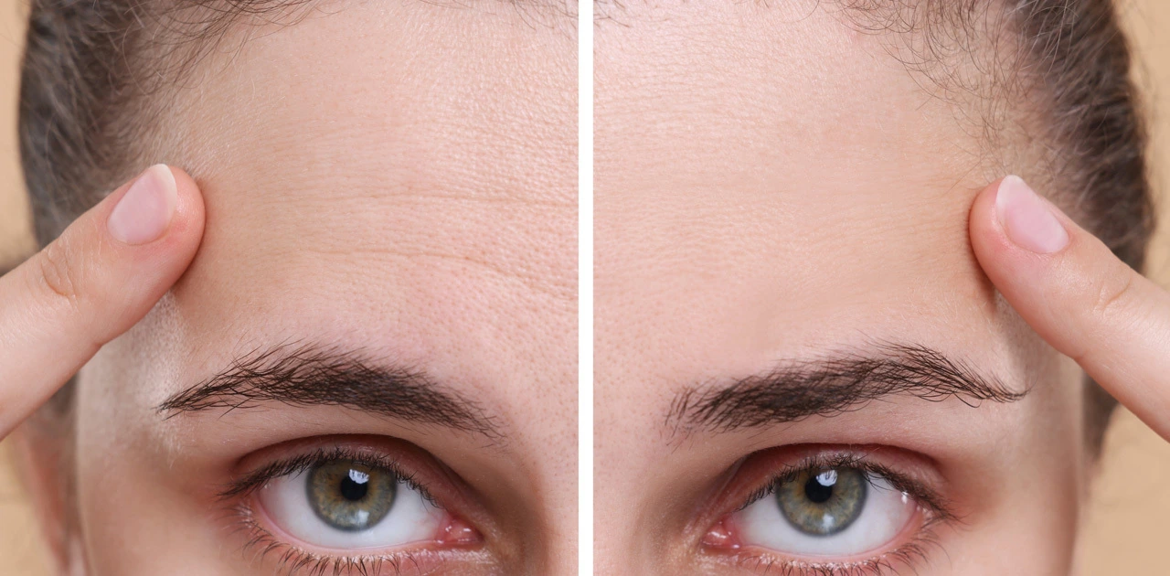 Forehead lines Botox treatment