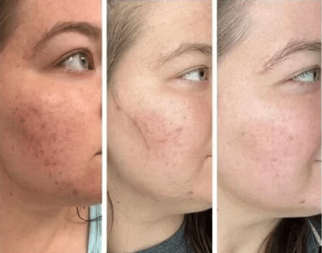 Microneedling for pigmentation