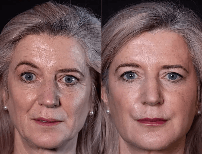 Cheek filler treatment