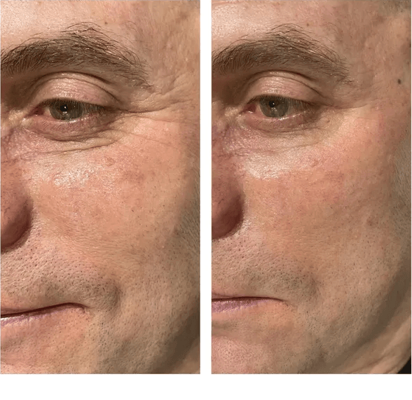 Microneedling facial rejuvenation