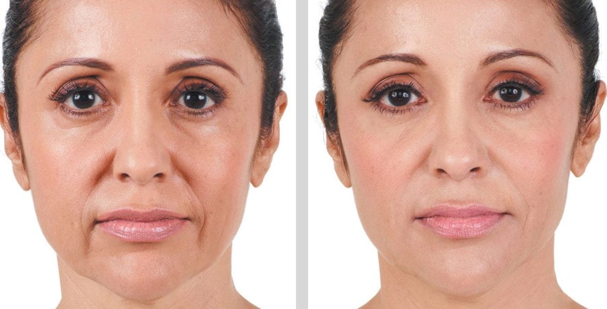 Nasolabial and marionette line fillers