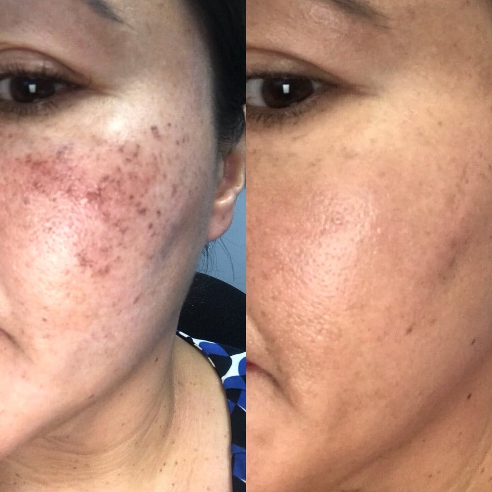 PRP acne scar treatment