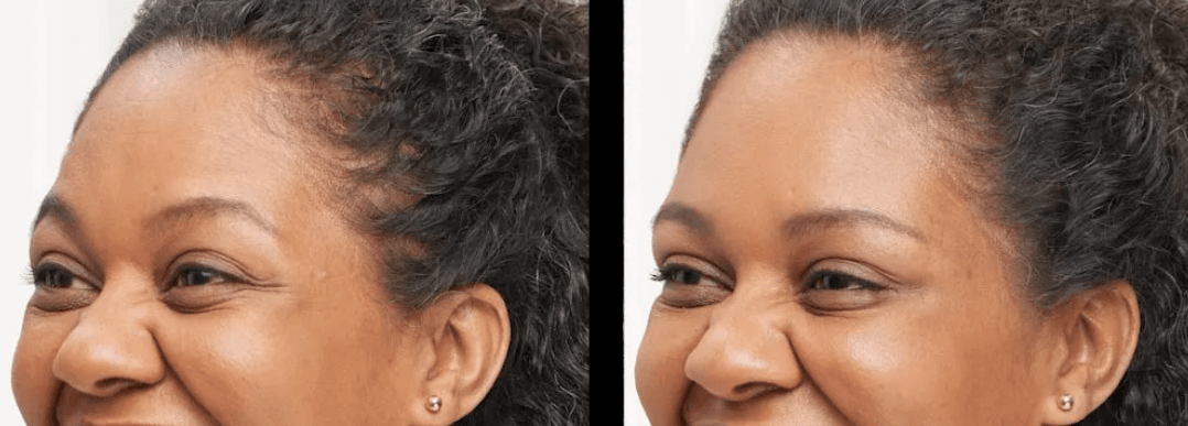 Crow's feet eye wrinkles