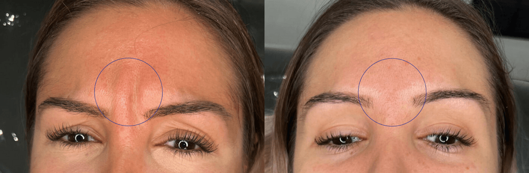 Frown lines glabellar treatment