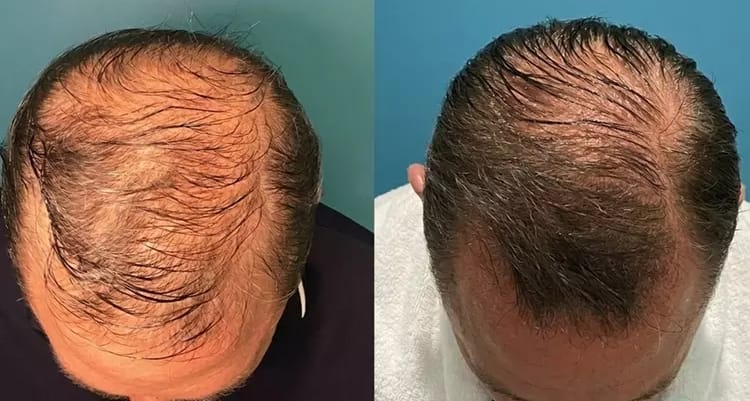 PRP hair restoration scalp treatment