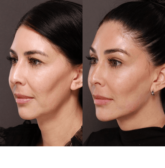 Chin and jawline filler treatment
