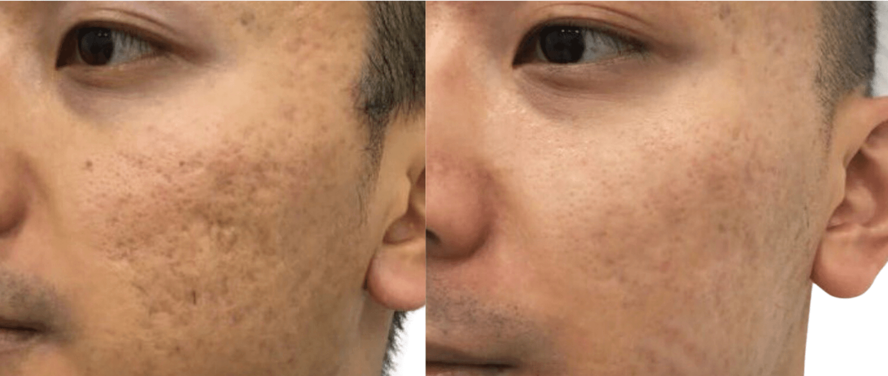 Microneedling for acne scars