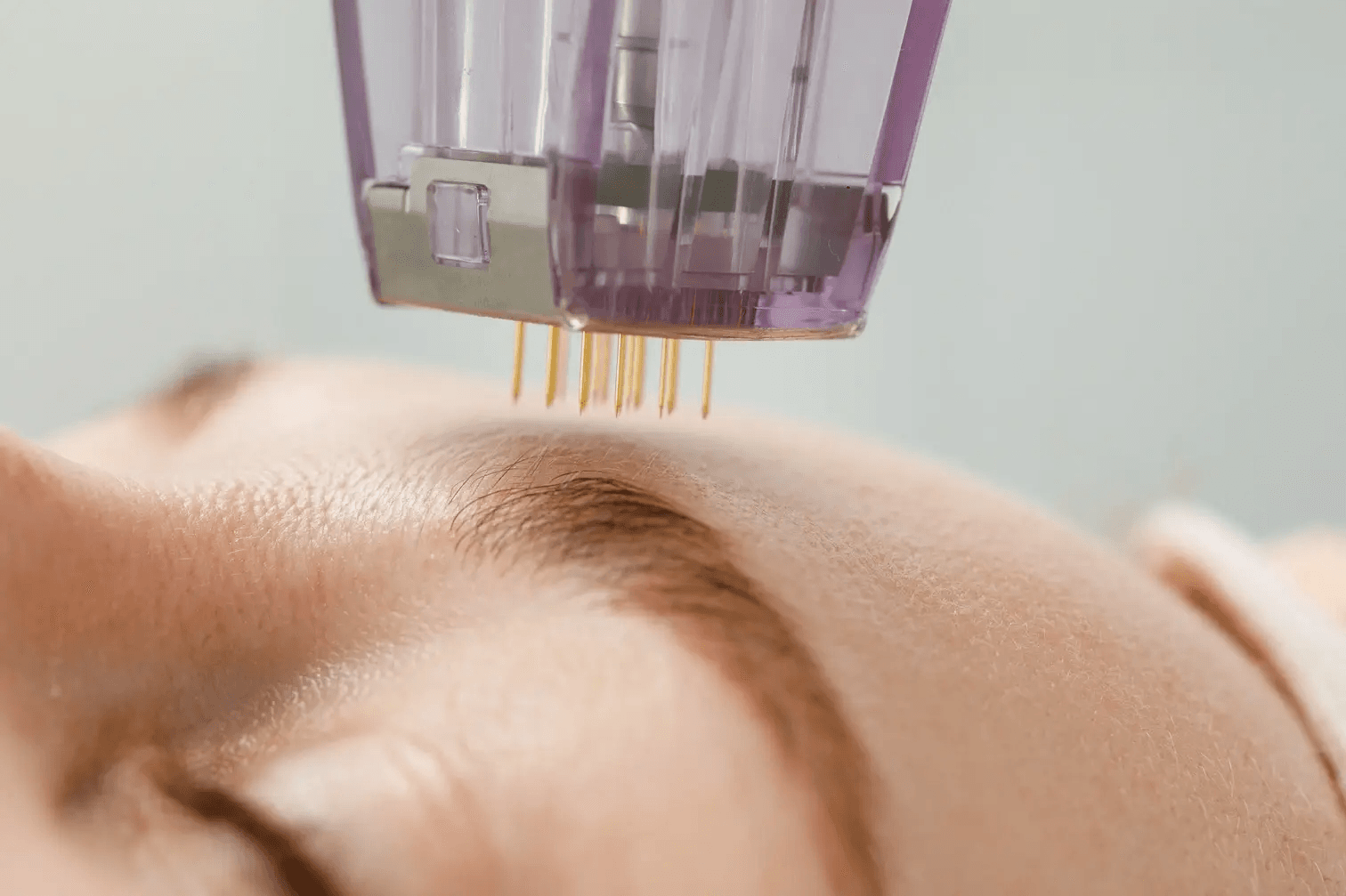 Microneedling collagen induction therapy