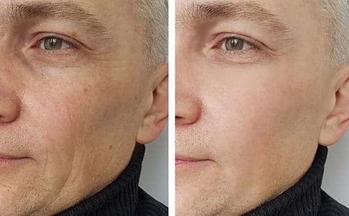 PRP facial rejuvenation treatment
