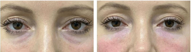 PRP under eye dark circles treatment