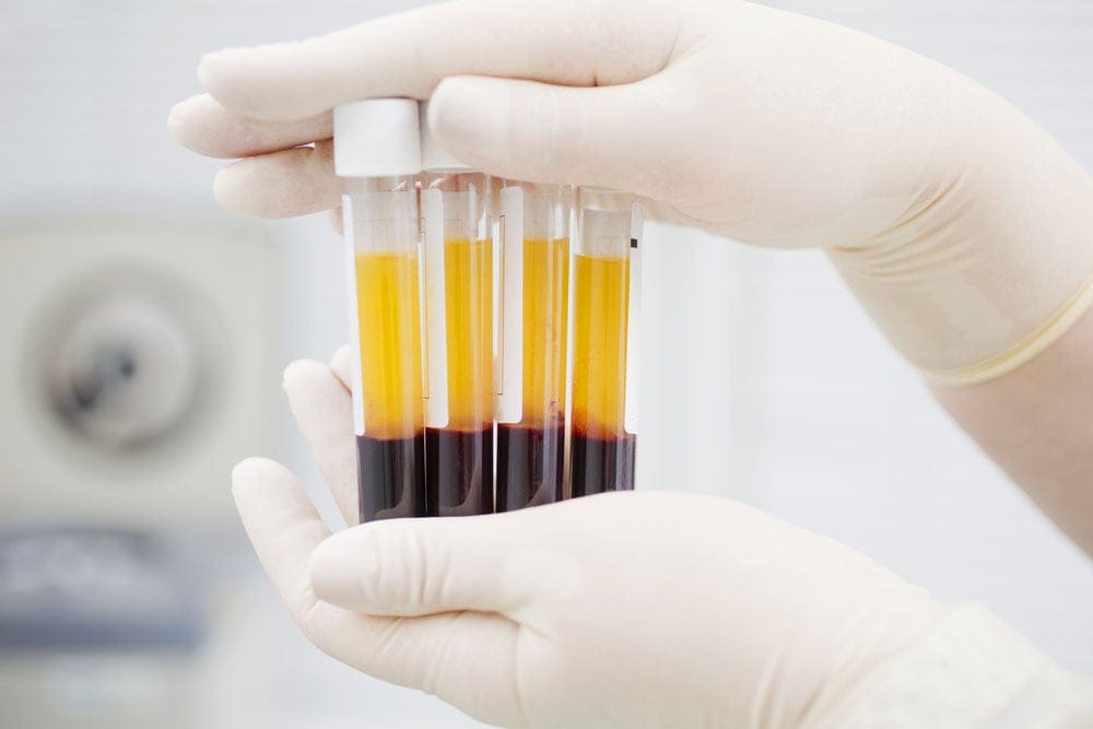 PRP blood processing and centrifuge technique