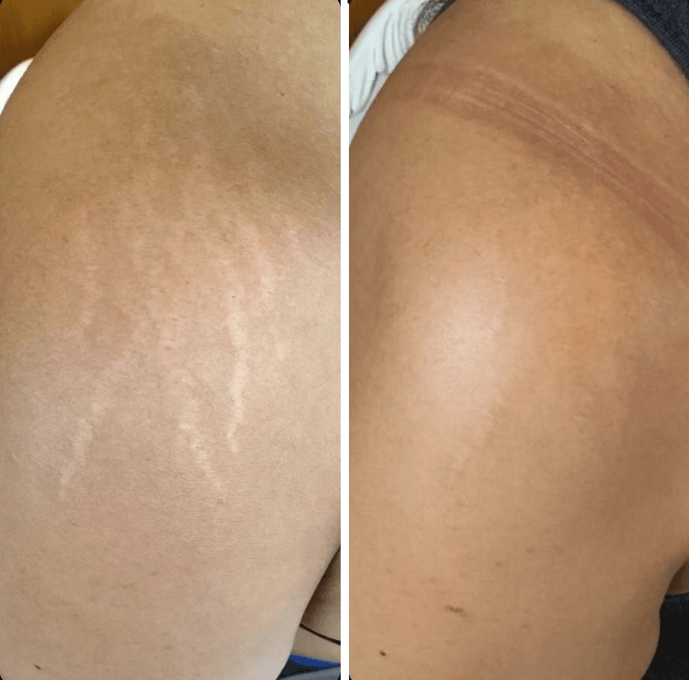 Microneedling for stretch marks
